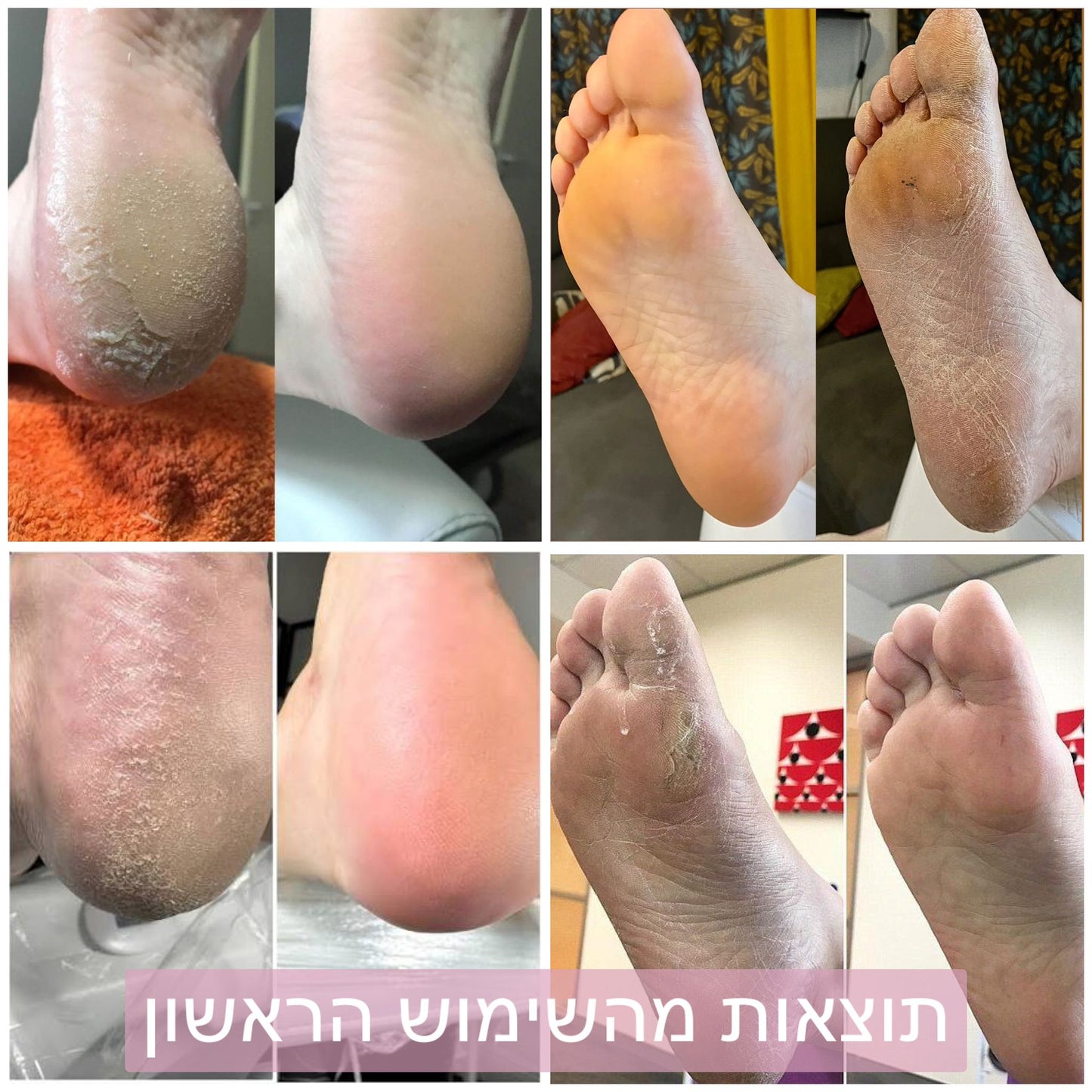 מכשיר פדיקור ביתי עור יבש